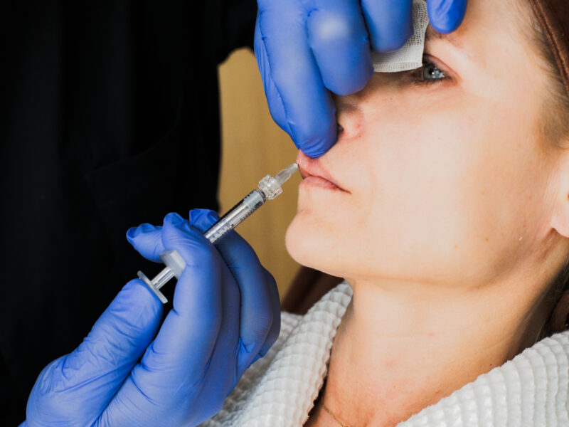 Modelowanie ust kwasem hialuronowym — wszystko, co powinieneś wiedzieć o tym zabiegu